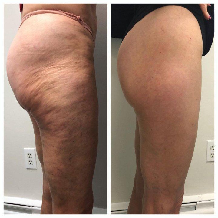 Natravor® Flex Shape Leggings-3-fache Fettverbrennung – Fett wird sogar im Sitzen verbrannt.