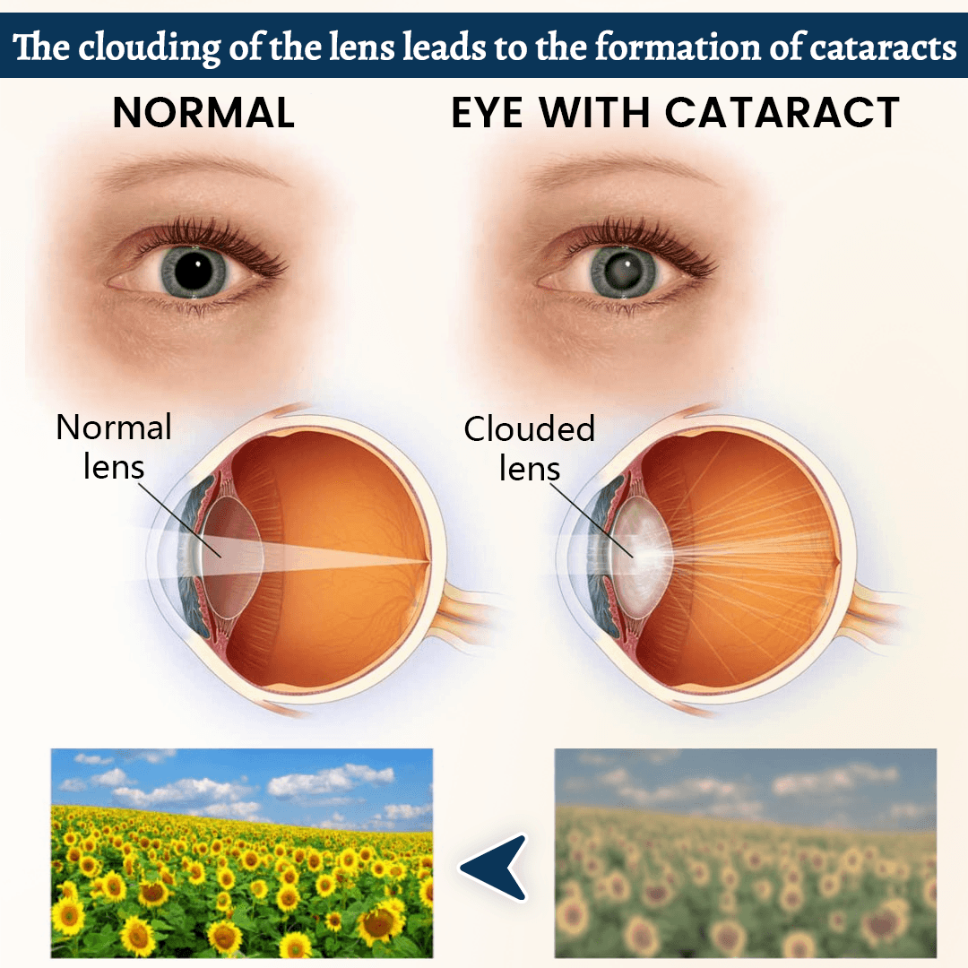 Qevnixo OptiFusion Vision Support Eye Patch